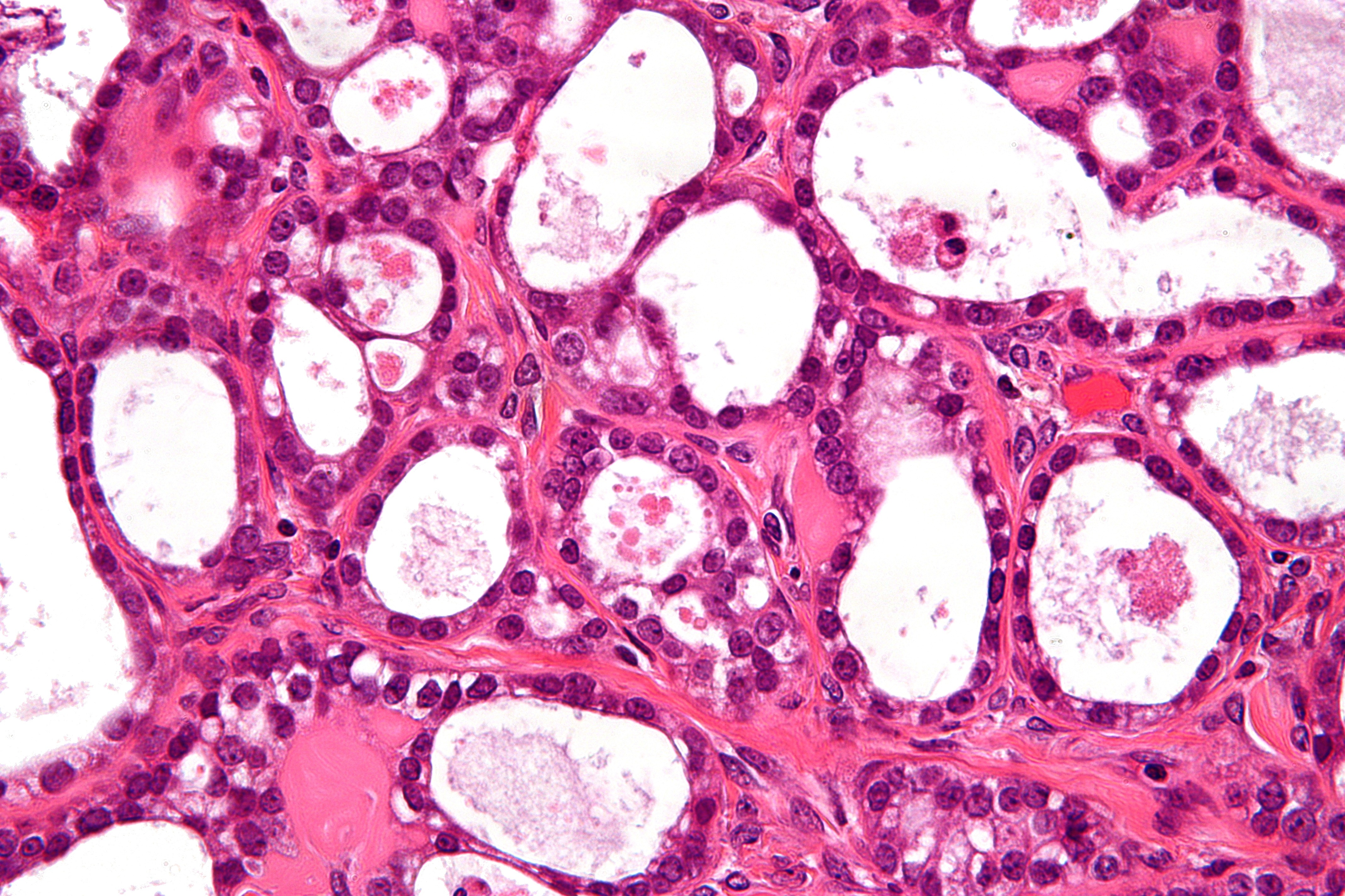 Ovarian-clear-cell-carcinoma--a--very-high-mag_2.jpg